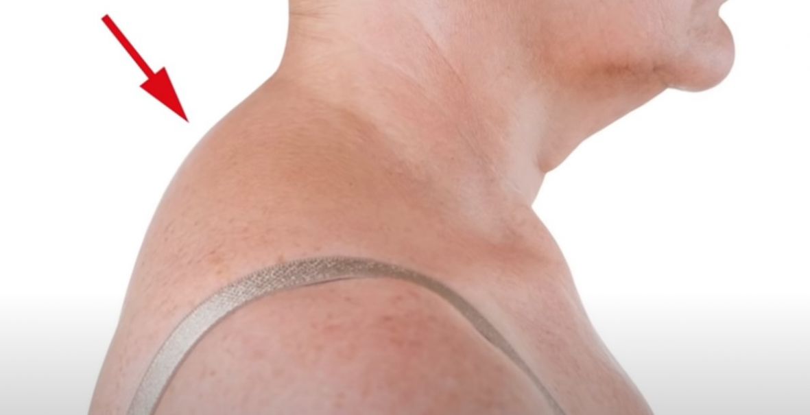Ako imate “grbu” na vratu, ove vježbe od četiri minute će vam biti spas