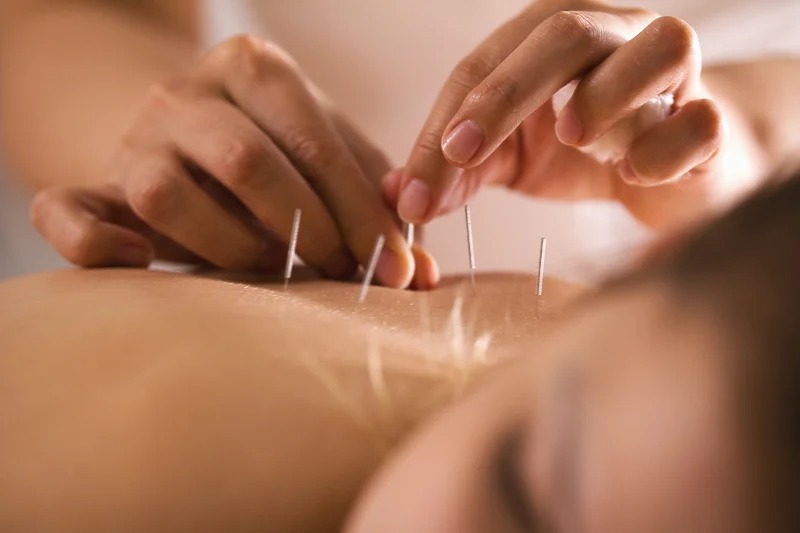 Šta je akupunktura i koje dobrobiti ima