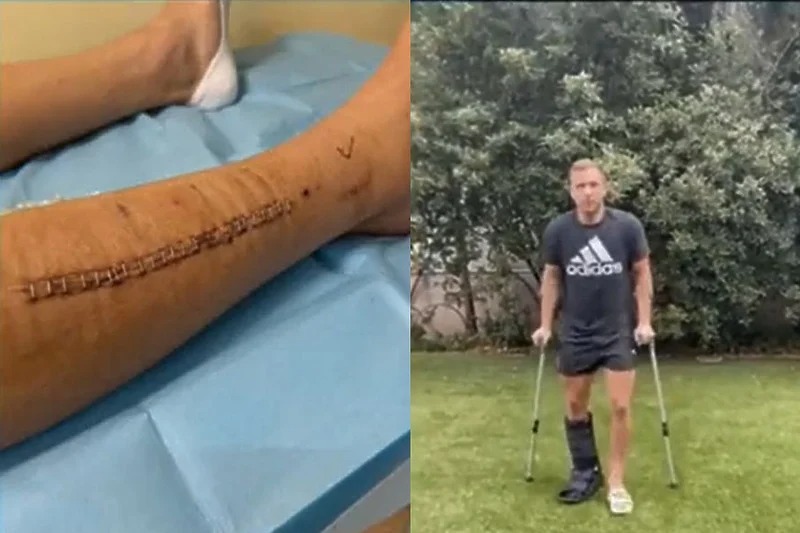 Nogometaš Juventusa pokazao jeziv izgled noge nakon operacije i uspješnog oporavka