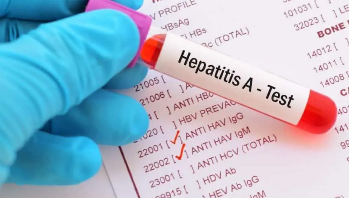 U regiji se pojavila epidemija hepatitisa A, uglavnom zaraženi srednjoškolci